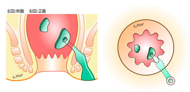 痔瘻・肛門周囲膿瘍まとめ | よくわかる大腸肛門科